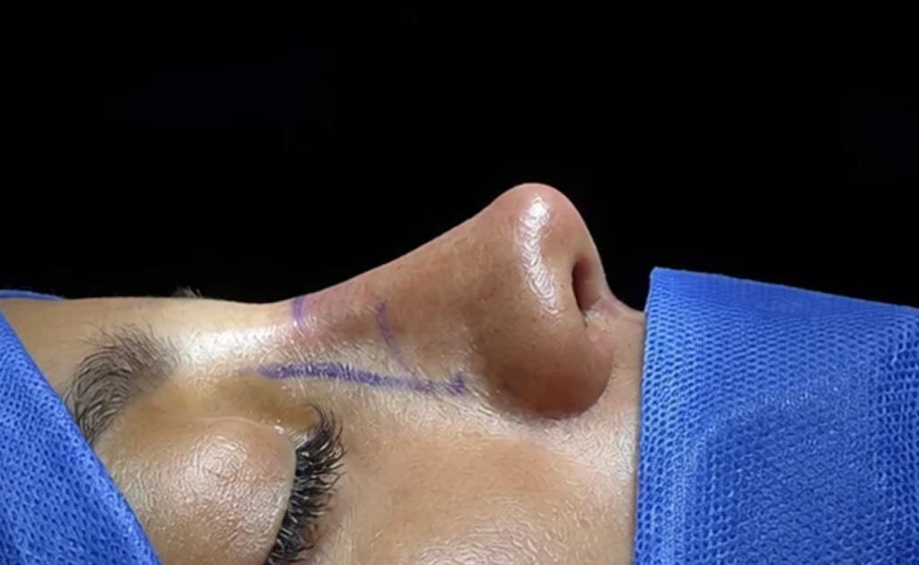 Caso de rinoplastia — después